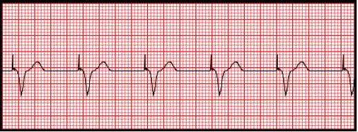 ECG, EKG, Electrocardiogram, Cardiology Image of chest placement for ECG leads